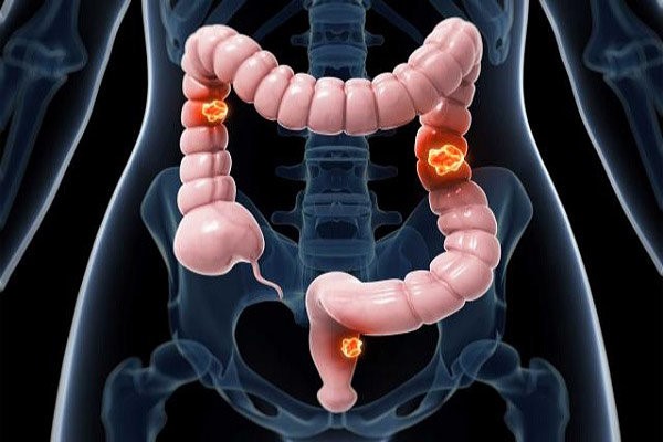 ارتباط چاقی با افزایش ریسک ابتلا به سرطان روده بزرگ