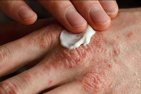 افزایش ابتلا به اگزما در افراد دارای پوست خشک در فصل سرما