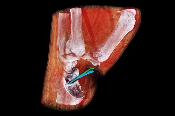 اسکنر اشعه ایکس رنگی سه بعدی از رگ‌ها عکس می‌گیرد
