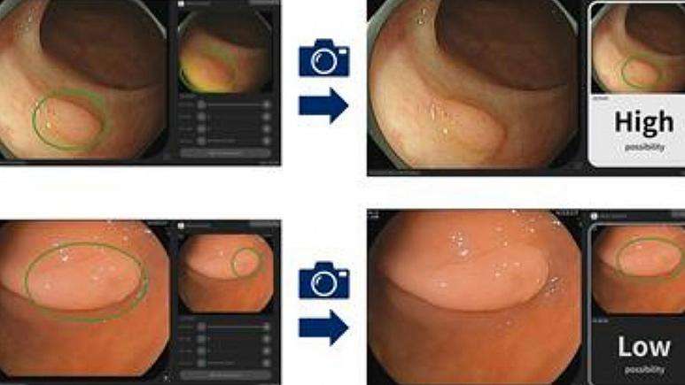 استفاده از هوش مصنوعی برای تشخیص زودهنگام سرطان روده بزرگ
