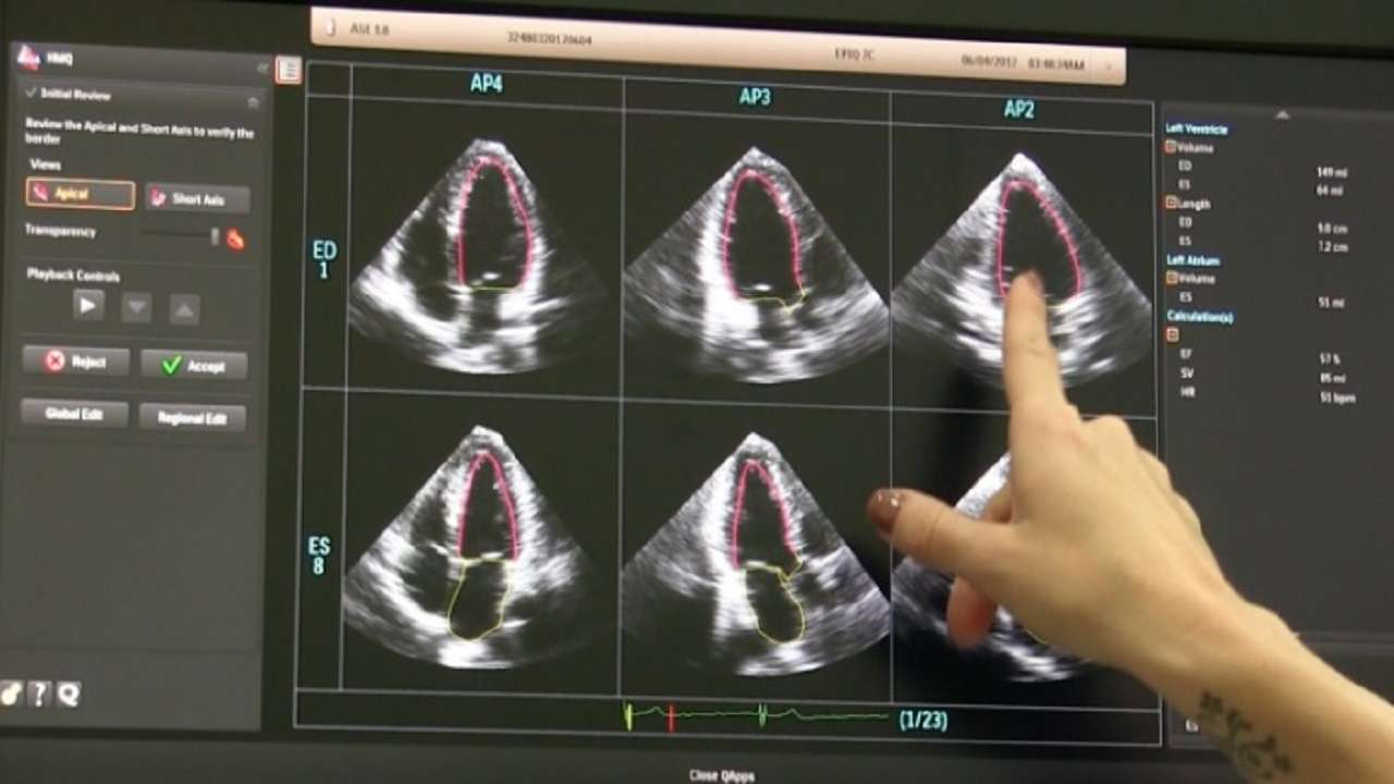 استفاده از هوش مصنوعی در تشخیص بیماری‌های قلبی در سونوگرافی
